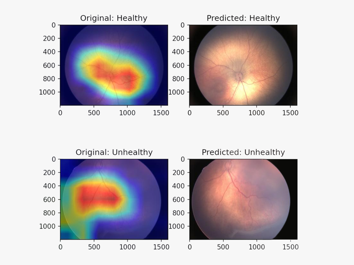 Grad-CAM decision visualization for retinopathy detection